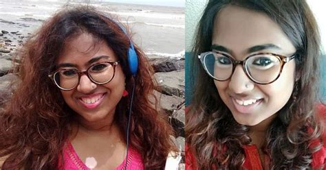 For a nation obsessed with white skin, India still sees vitiligo as ...