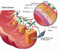 colorectal cancer 的图像结果