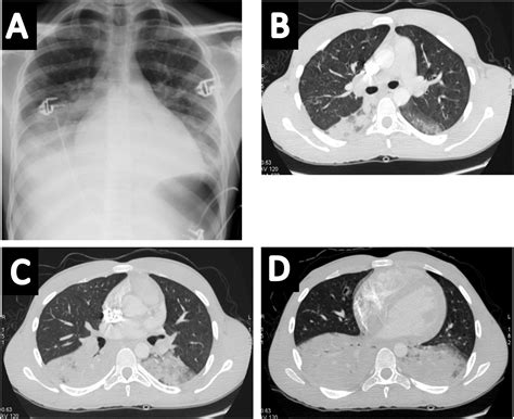 What Is The Meaning Of Chest Syndrome at Hilda Woolsey blog