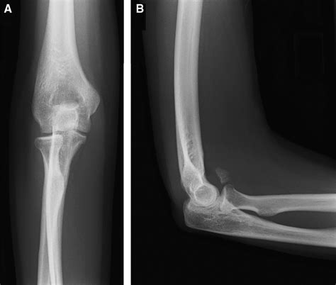 Isolated anterolateral fracture of the coronoid process of the ulna: a case report - Journal of ...