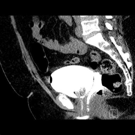 Image result for Cystogram Procedure for CT Scan