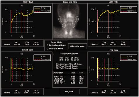 Sjögren’s syndrome positive for isolated anti-Ro52/SS-A antibody and ...