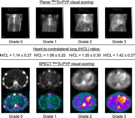 What Is Cardiac Amyloidosis