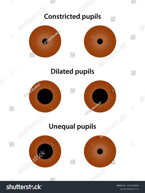 Fixed Dilated Pupils