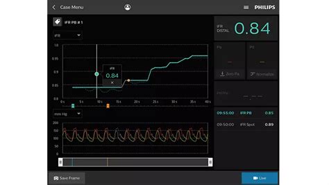 OmniWire - Pressure guide wire product information | Philips