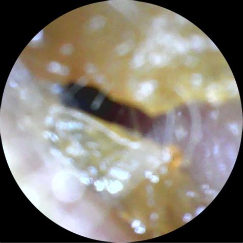 Ear Wax Removal Calverton - Happy Ears Clinic Nottingham