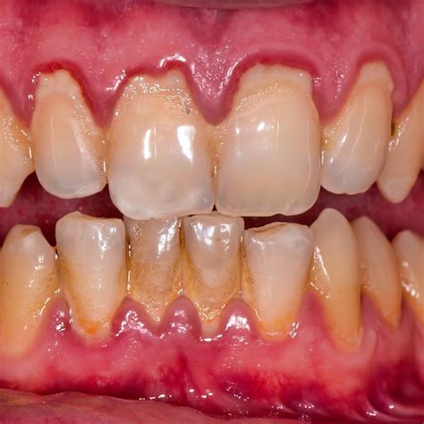 Tooth Recession 的图像结果