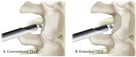 Clinical Efficacy of Extended Transforaminal Endoscopic Lumbar ...