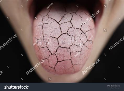 Dry Mouth Cause Cracked Tongue at Kim Jean blog