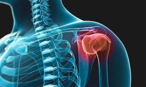 Positive Outcomes for Rotator Cuff Healing with Bioinductive Collagen ...