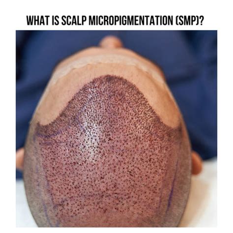 Top 8 Regrets People Have After Scalp Micropigmentation | Clinikally