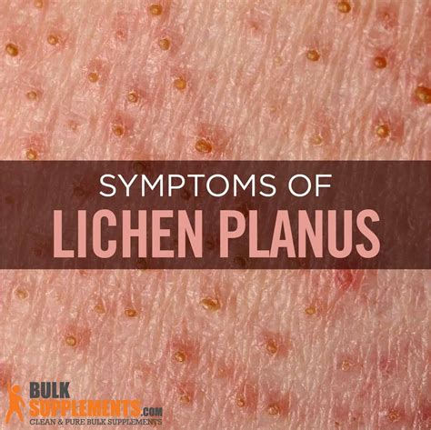 Lichen Planus. it's Time for Relief. Treatment for Rashes & Dental Pain