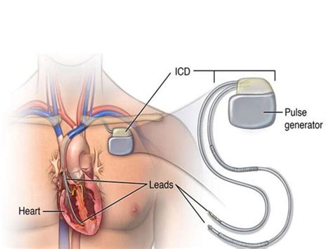 Pacemaker Procedure 的图像结果