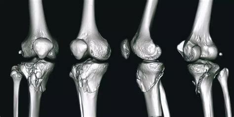 Delay in surgical fixation may lead to failure to Achieve Fracture ...