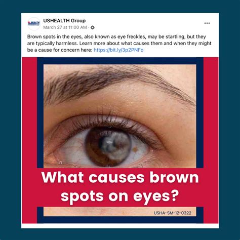 What Causes Brown Spots On Eyes? | Spots in eyes, Health insurance plans, Health insurance agent