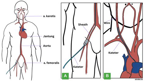 Cerebral Digital Subtraction Angiography (DSA) - Stroke.ID