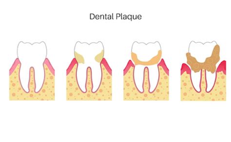 Learn What Dental Plaque is & How it is Formed – Perfora - Oral Care ...