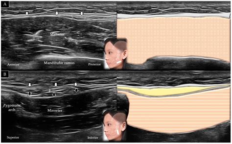 Ultrasound Imaging of the Facial Muscles and Relevance with Botulinum ...