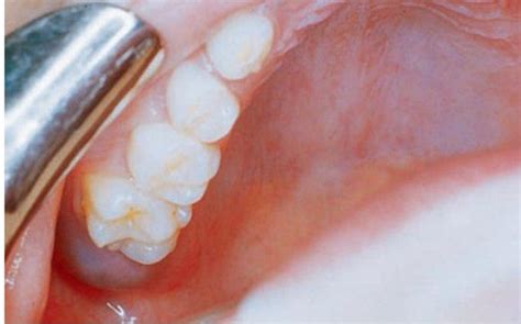 Image result for Exploding Mouth Cyst