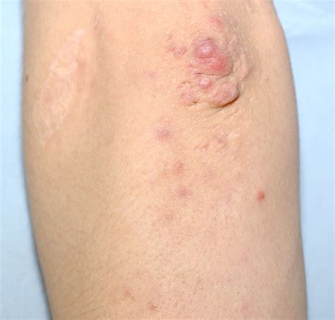 Ehlers–Danlos syndrome: how to diagnose and when to perform genetic tests | Archives of Disease ...