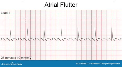 Image result for Atrial Flutter ECG Pattern