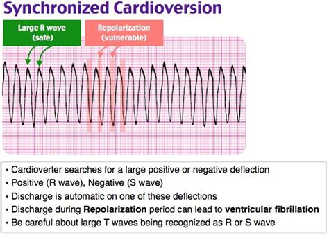 Image result for Synchronized Cardioversion Rhythm Strip