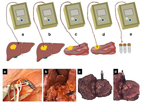 Electrical Conductivity Measurement in Human Liver Tissue: Assessment ...