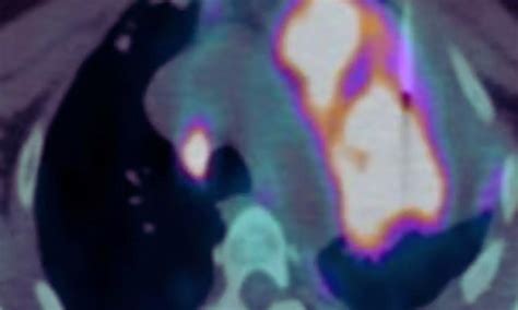 PET/CT before percutaneous needle lung biopsy improves diagnostic ...