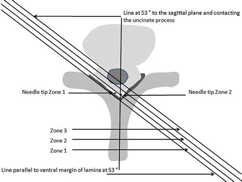 Image result for Contralateral Oblique View