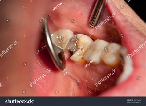 Broken Molar Tooth