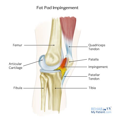 Fat Pad Impingement