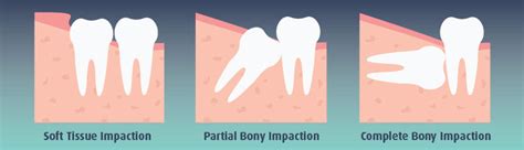 Image result for Wisdom Teeth Impaction Types