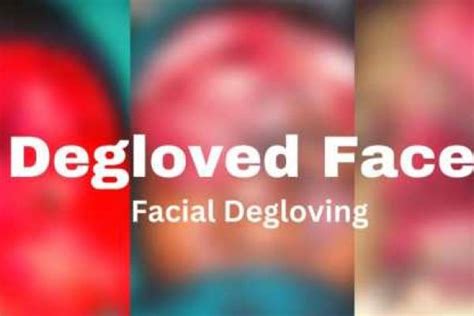 Understanding The Gruesome Reality Of Degloved Faces: Causes, Treatment ...