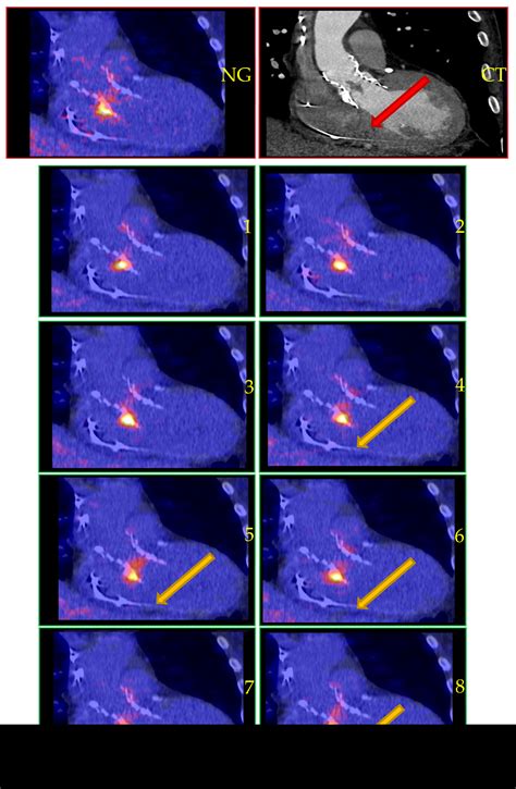 Improved [18F]FDG PET/CT Diagnostic Accuracy for Infective Endocarditis ...