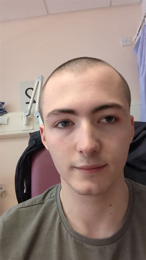 Before and after second surgery. Lots of swelling and woke up from ...