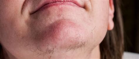 HIRSUTISM TREATMENT
