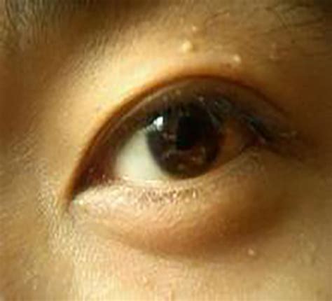 【图】眼睛上长脂肪粒怎么办呢 8大妙招解决你的问题_眼睛上长脂肪粒怎么办_伊秀美容网|yxlady.com