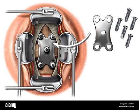 Anterior Cervical Discectomy And Fusion Stock Photos & Anterior Cervical Discectomy And Fusion ...