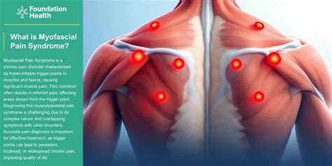 Myofascial pain syndrome | Foundation Health Osteopathy | (02) 6681 6249 | What is myofascial ...