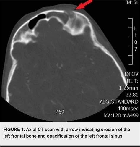 Figure 1 from Pott’s Puffy Tumor: A Potentially Deadly Complication of Sinusitis | Semantic Scholar