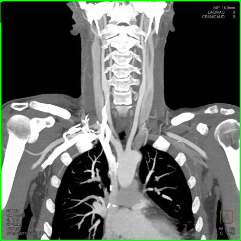 Normal CTA of the Neck - Neuro Case Studies - CTisus CT Scanning