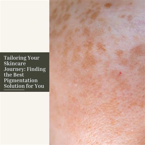 How Microneedling Can Help with Skin Pigmentation | Clinikally