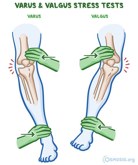 Varus Vs Valgus Fracture