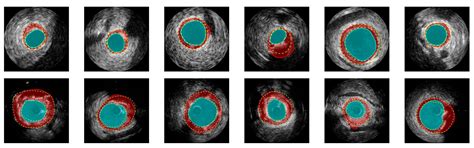 Advanced Ultrasound and Photoacoustic Imaging in Cardiology