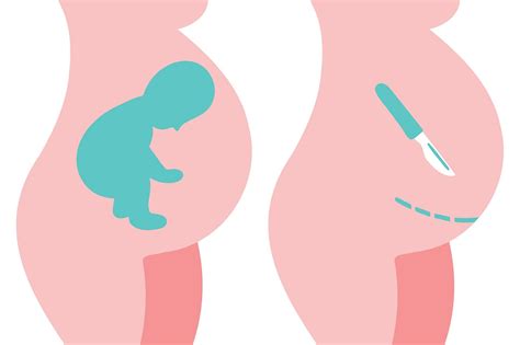 Оперативное родоразрешение при ягодичном предлежании плода — Teletype