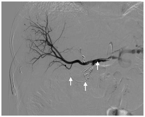 Percutaneous Implantation of a Microcatheter-Port System for Hepatic ...