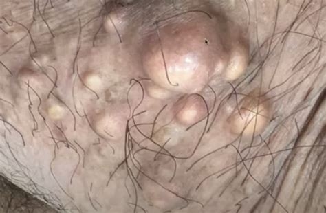 Image result for Sebaceous Cyst Removal Procedure