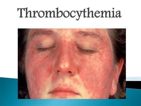 PPT - Thrombocythemia: Causes, Symptoms, Diagnosis, and Treatment PowerPoint Presentation - ID ...