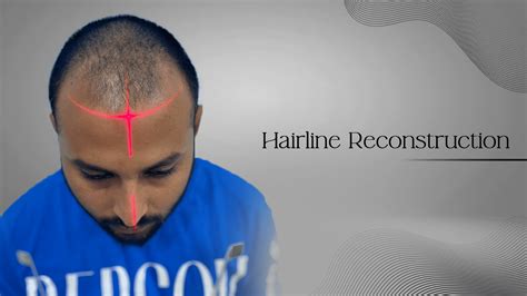 Hair Transplant Surgeon in Navi Mumbai | Dr. Bhavesh Gupta