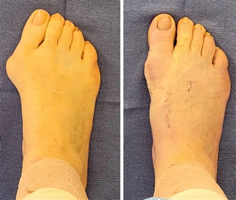 Foot Discoloration After Bunion Surgery at Colby Westlake blog